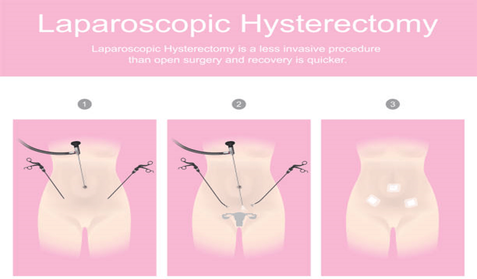 Laparoscopic Hysterectomy: 